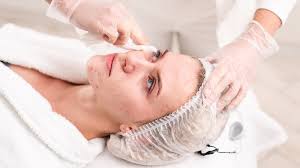 Dealing with Acne
